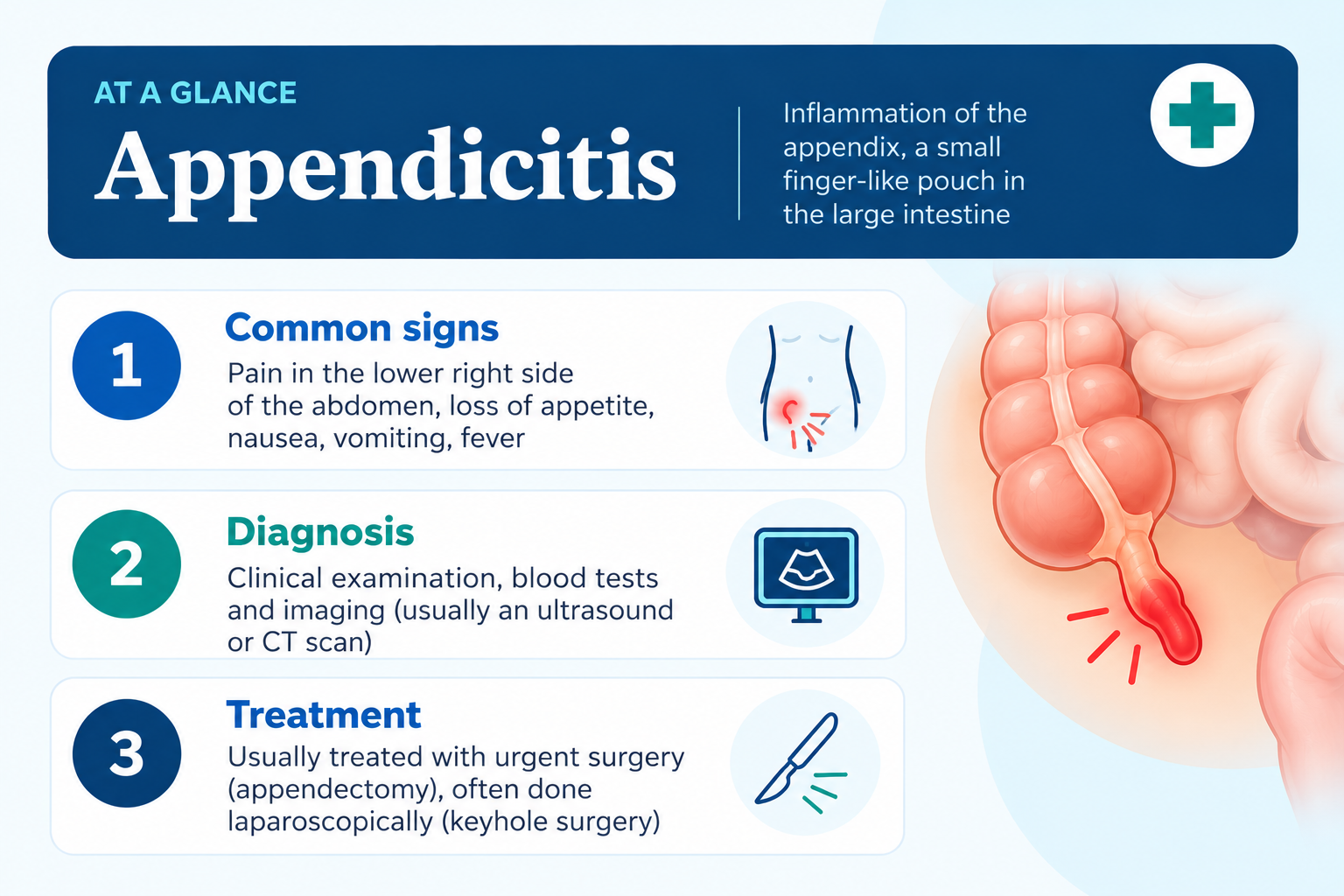 Appendicitis infographic